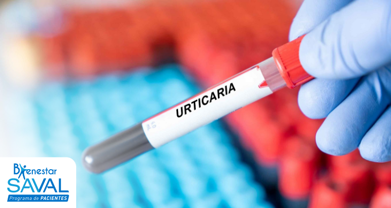 urticaria causas sintomas tratamiento